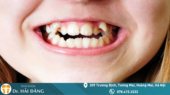 Read more about the article Bọc răng sứ răng khểnh thông tin cần biết