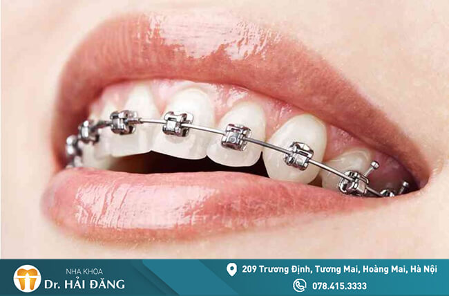 Read more about the article Nên niềng răng hô bằng phương pháp nào?