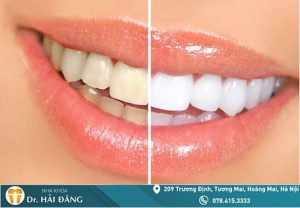 Read more about the article Cách giảm ê buốt răng sau khi tẩy trắng răng