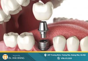 Read more about the article Quy trình cấy ghép implant