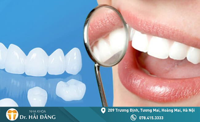 Read more about the article Bọc răng sứ có bền không sử dụng được bao lâu?