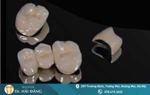 Read more about the article Có nên lựa chọn răng sứ kim loại hay không?