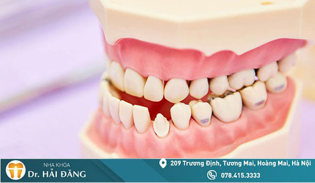 Read more about the article Niềng răng móm có hiệu quả không? Chi phí bao nhiêu?