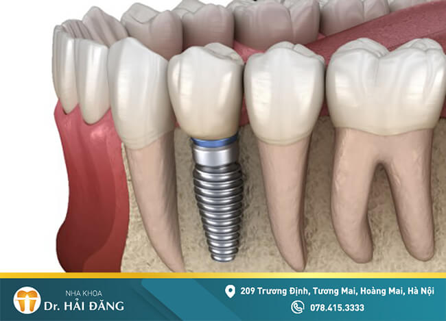 Read more about the article Cấy ghép implant toàn hàm giải pháp cho người mất nhiều răng