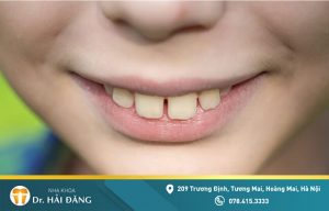 Read more about the article Bọc răng sứ cho răng hô liệu có thực sự hiệu quả?