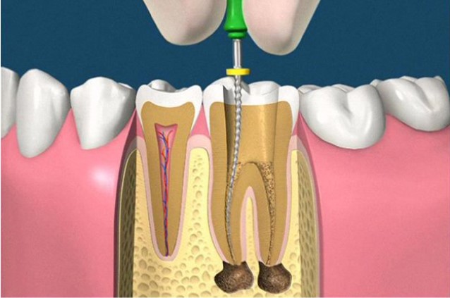 Read more about the article Bọc răng sứ có lấy tủy không?
