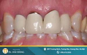 Read more about the article Nhận biết và khắc phục chân răng sứ bị hở