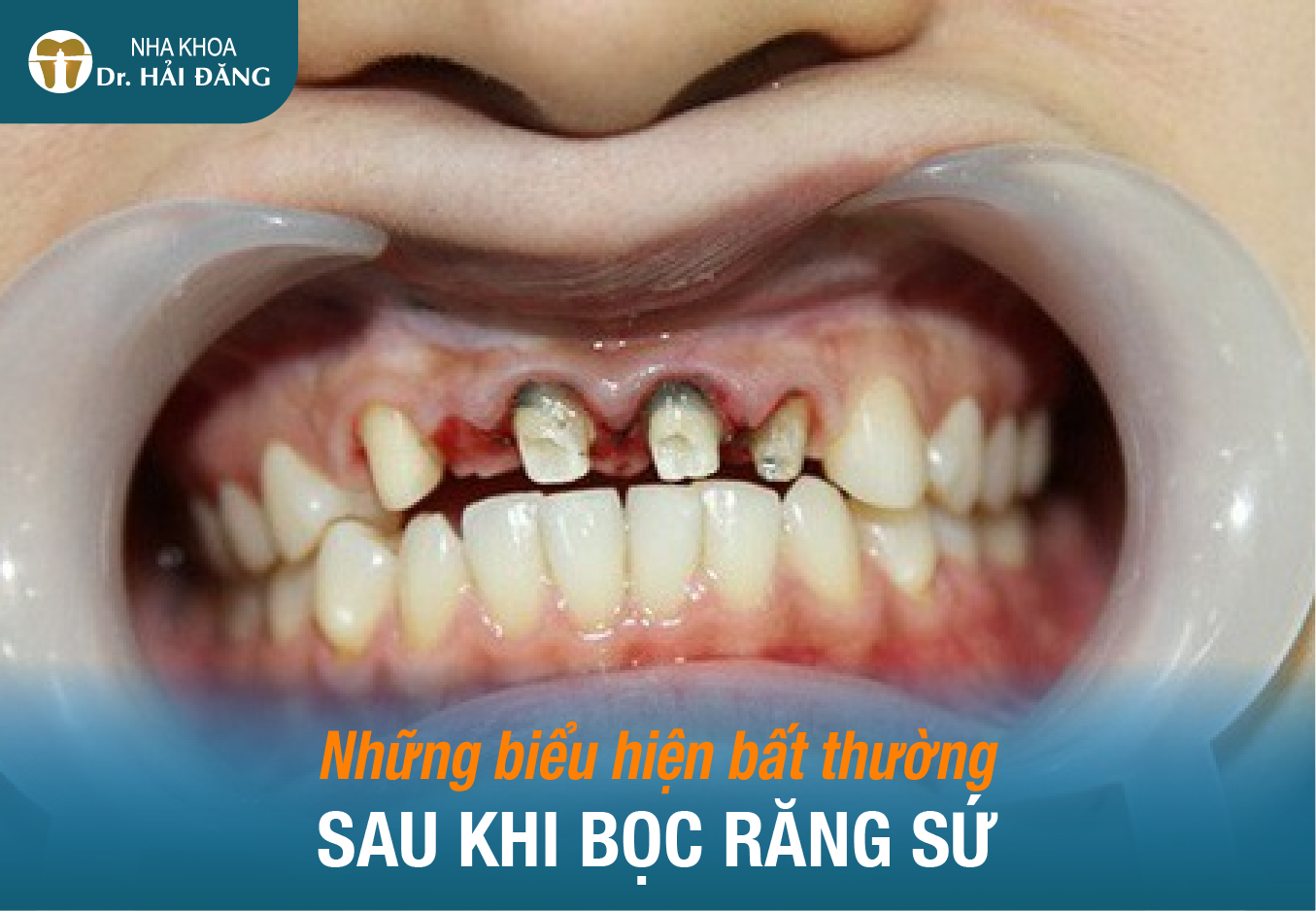 Read more about the article Những biểu hiện bất thường sau khi bọc răng sứ