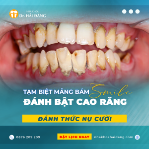 lấy cao răng