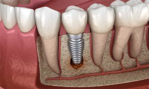 đào thải trụ implant