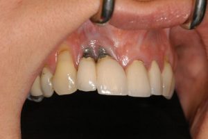 nhiễm trùng vùng cắm implant